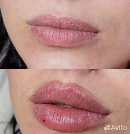 Контурная пластика, увеличение губ