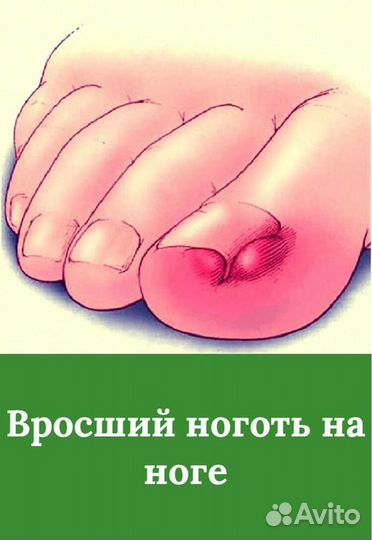 Педикюр для проблемных стоп.Вросший ноготь