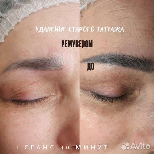 Удаление татуажа ремувером