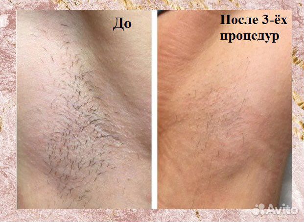 Электроэпиляция