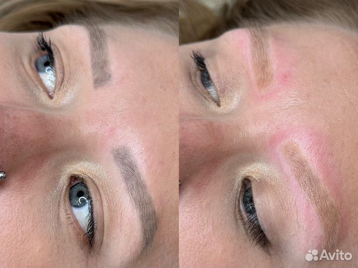 Удаление татуажа