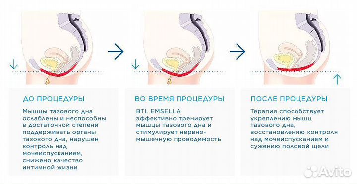 Кресло UmSella для укрепления мыщц тазового дна