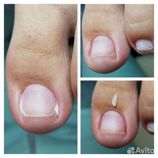 Подолог, педикюр, вросший ноготь, титановая нить