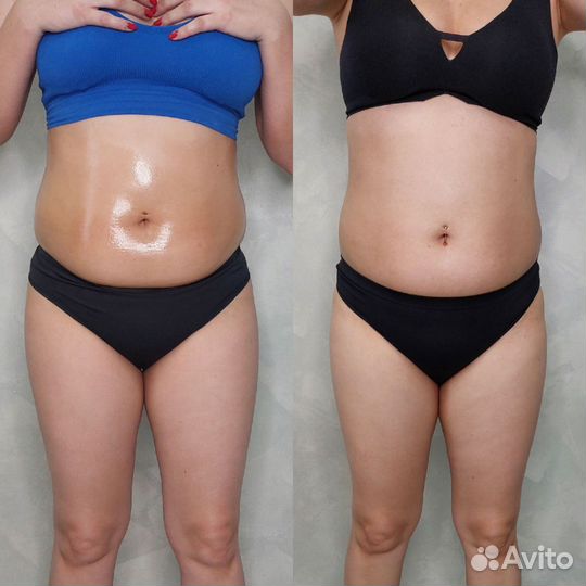 Аппаратный массаж, аппаратная коррекция фигуры