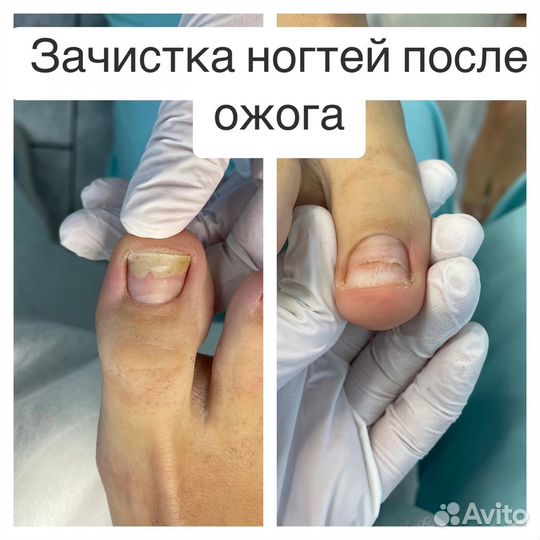 Педикюр подолог