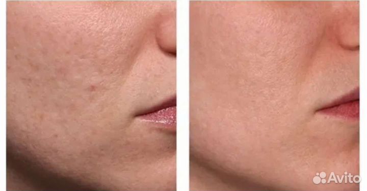 Карбокситерапия