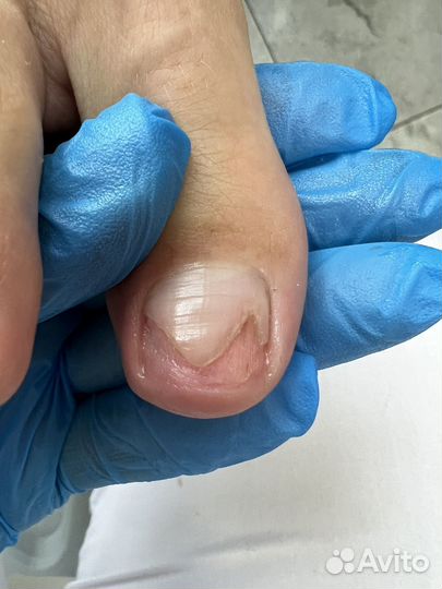 Отслоение Травмированный ноготь Подолог