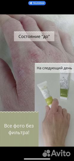 Крем Шици от псориаза