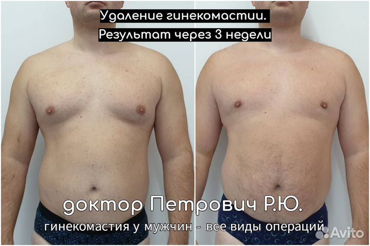 Лечение гинекомастии смешанной формы