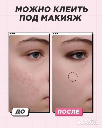 Патчи-наклейки от прыщей уход для лица