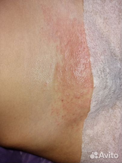 Электроэпиляция