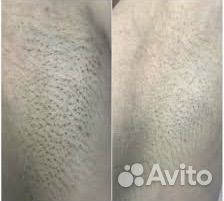 Лазерная эпиляция