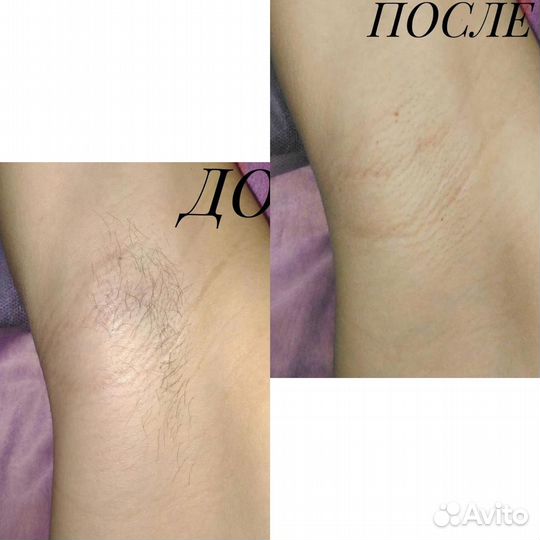 Шугаринг/сахарная и восковая депиляция