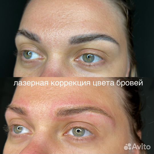Удаление татуажа