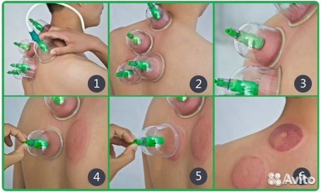 Вакуумные банки новый. Цена до 10.01