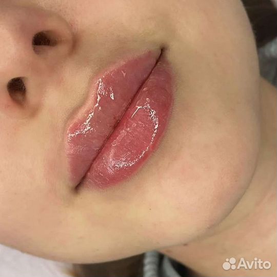 Увеличение губ