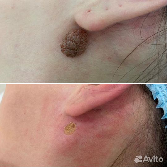 Удаление новообразований без шрамов и без боли