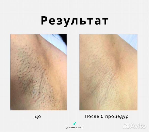 Аппарат для эпиляции Lumines Макс’Ван 1200 Вт