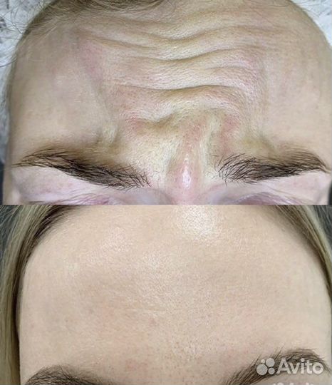 Ботокс для лица, ботулинотерапия