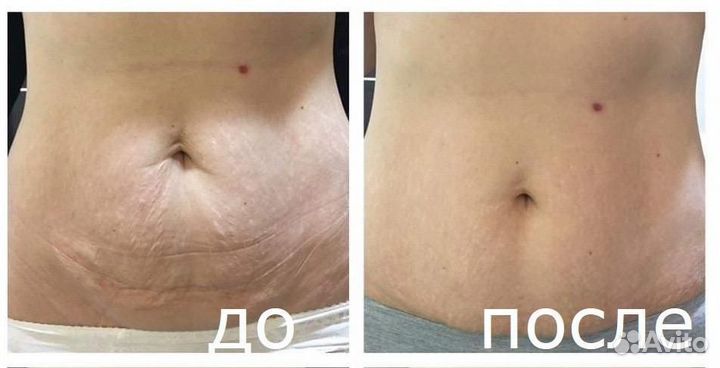 Аппаратный антицеллюлитный массаж