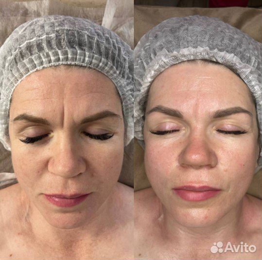 LPG массаж/вибро/вакуум/индиба