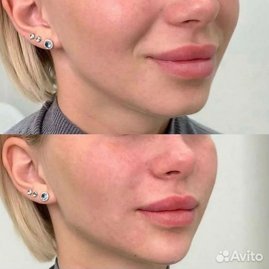Увеличение губ,Контурная пластика, профиль Джоли