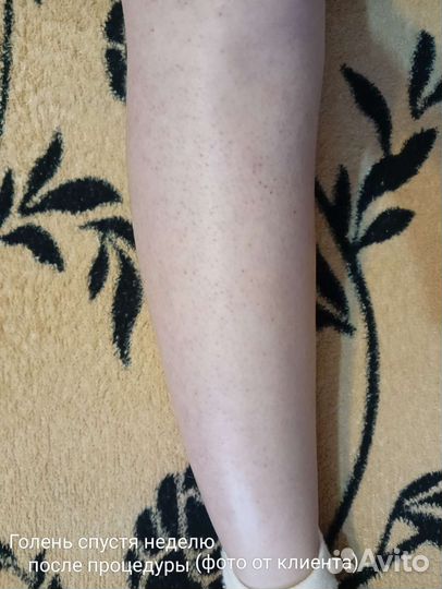 Электроэпиляция