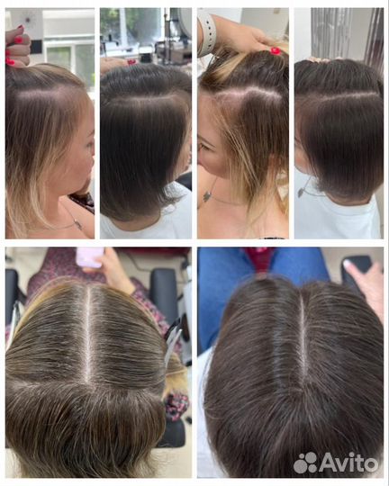 Безболезненное Восстановление роста волос