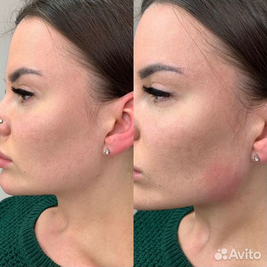 Увеличение губ, ботулинотерапия