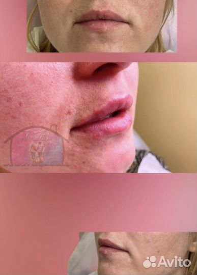 Увеличение губы