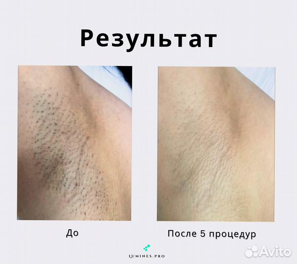 Аппарат для эпиляции Lumines’ Макс’Ван 1200в