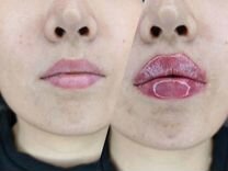 Увеличение губ врач косметолог