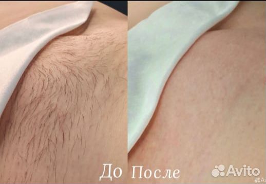 Шугаринг