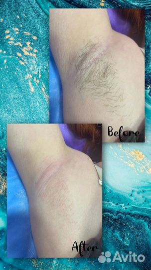 Мастер депиляции