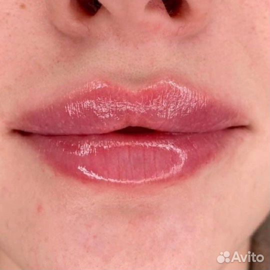 Увеличение губ