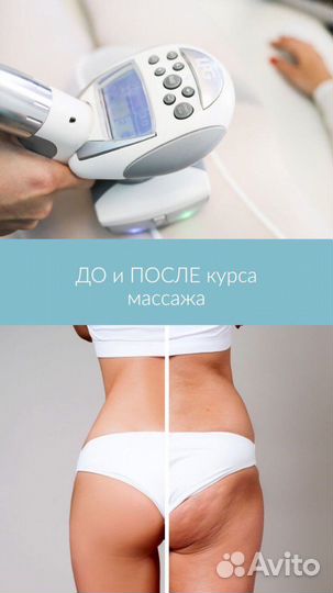 Лазер, LPG, коррекция фигуры,косметология