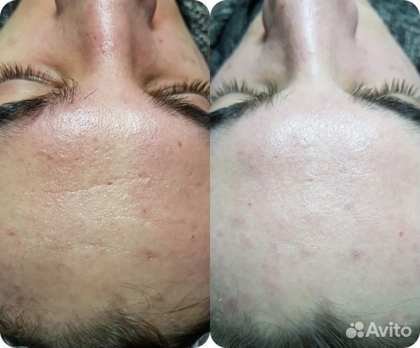 Чистка лица