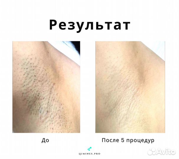 Диодный лазер для эпиляции Люминес’ Макс’Ван 1200