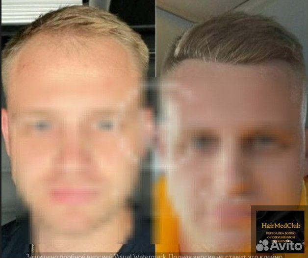 Пересадка волос Качество/ Гарантия/ Результат