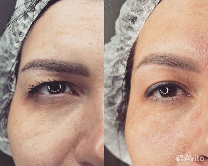 Плазменное омоложение мтуси 