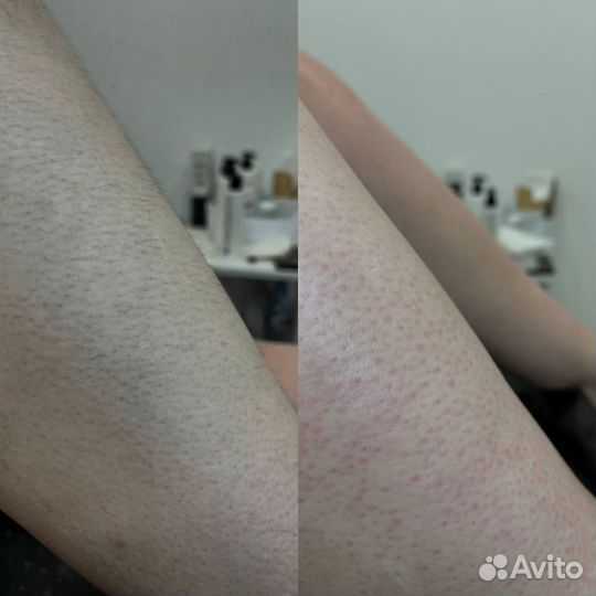 Восковая депиляция