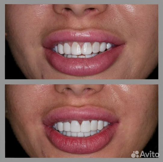 Накладки на зубы