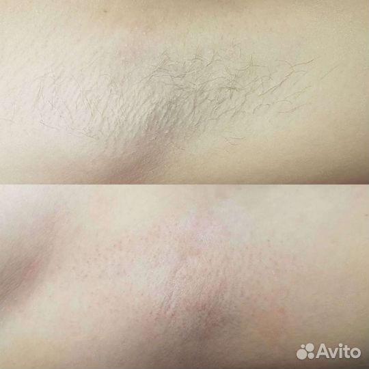 Депиляция воском