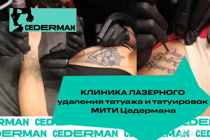 Удаление тату