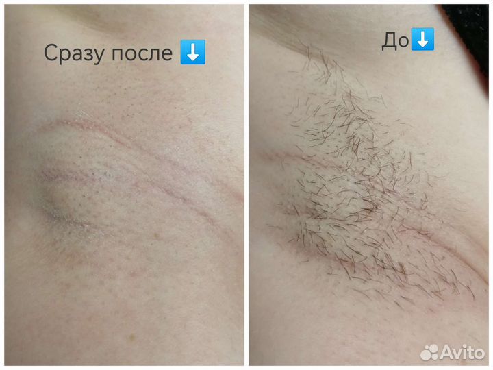 Электроэпиляция