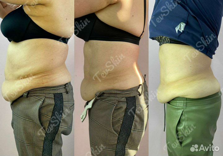 Липосоникс.Коррекция фигуры.Уменьшение объемов