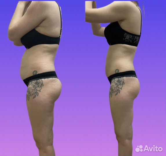 Спа процедуры (LPG Массаж)