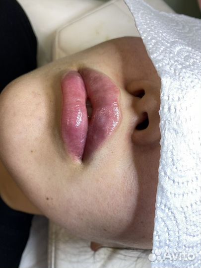 Увеличение губ