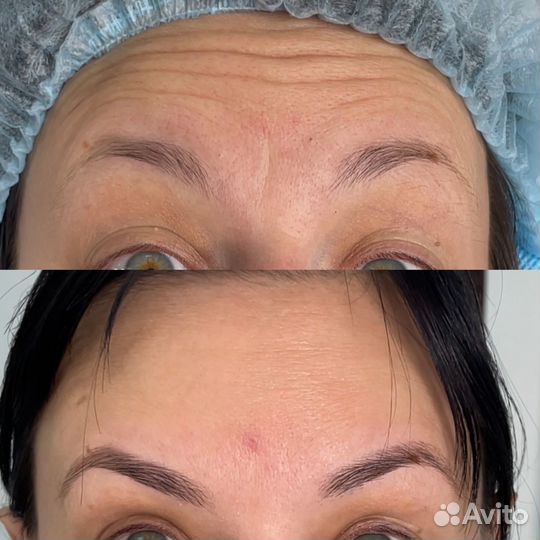 Ботокс для лица