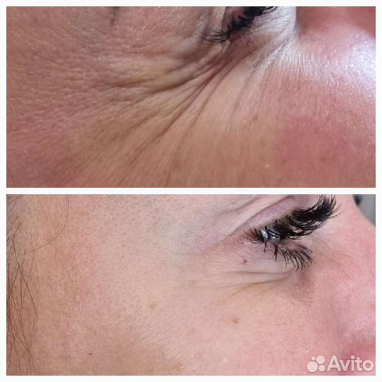 Инъекции ботокса в лоб